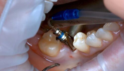 Osstem 46 Flapless 01 4K