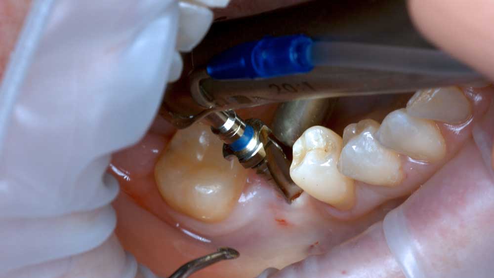 Osstem 46 Flapless – bone drilling part 1